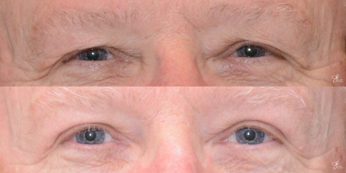 Eyelid Lift Before & After