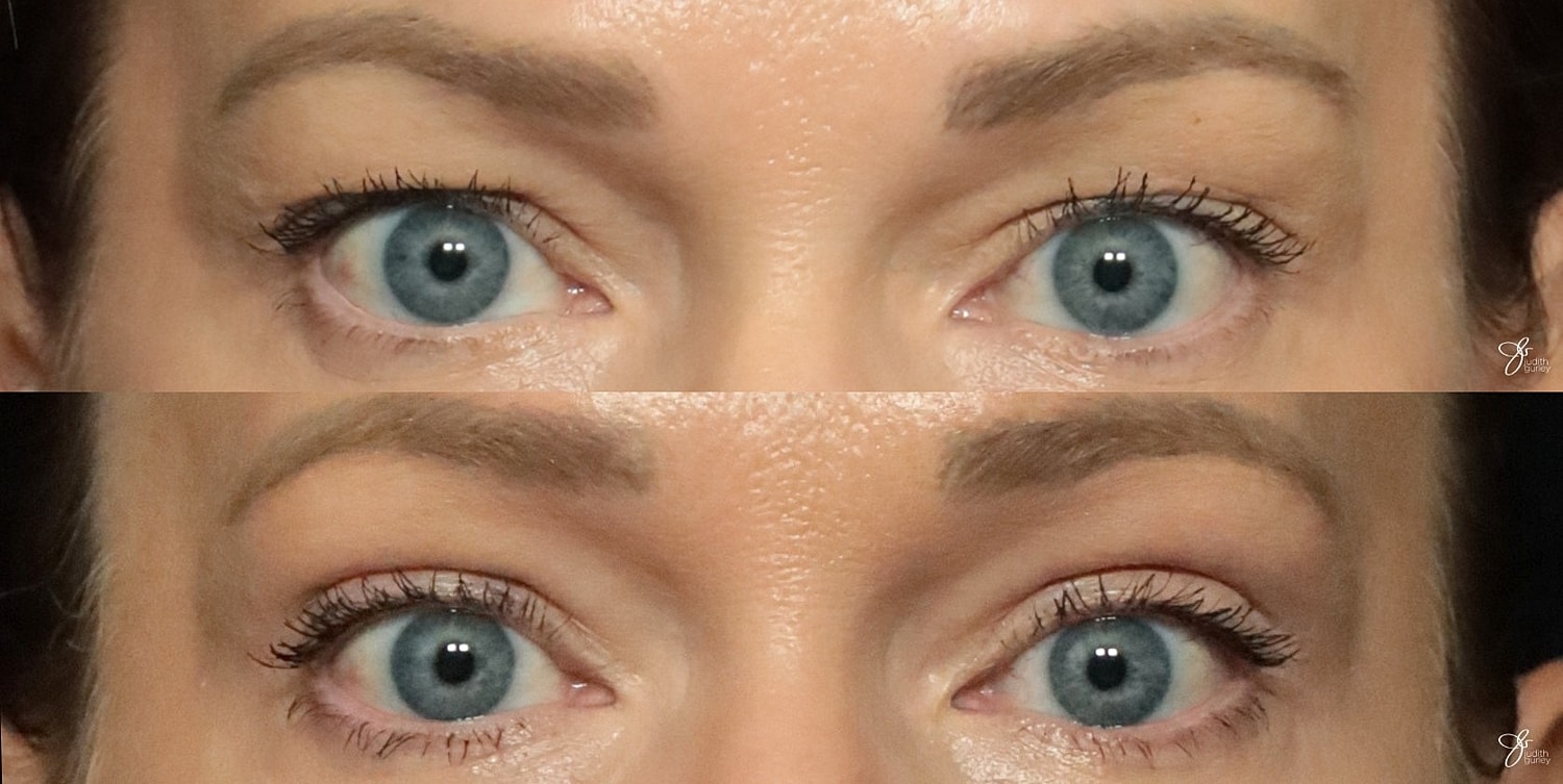 Eyelid Lift Before & After