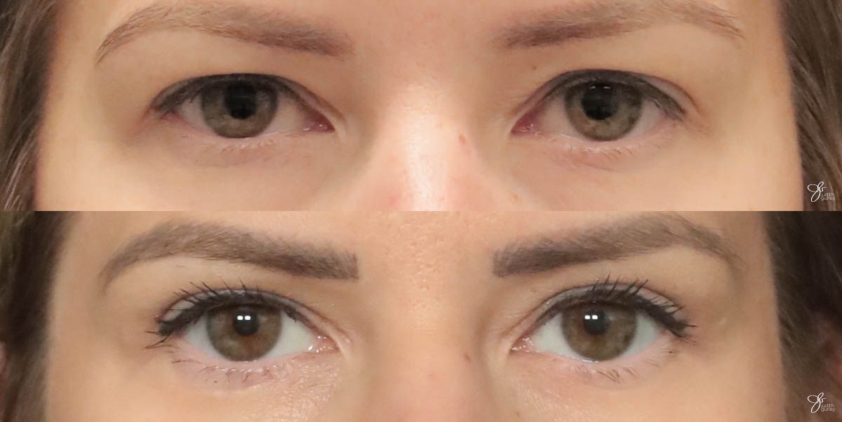 Eyelid Lift Before & After