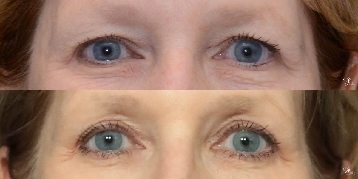 Eyelid Lift Before & After