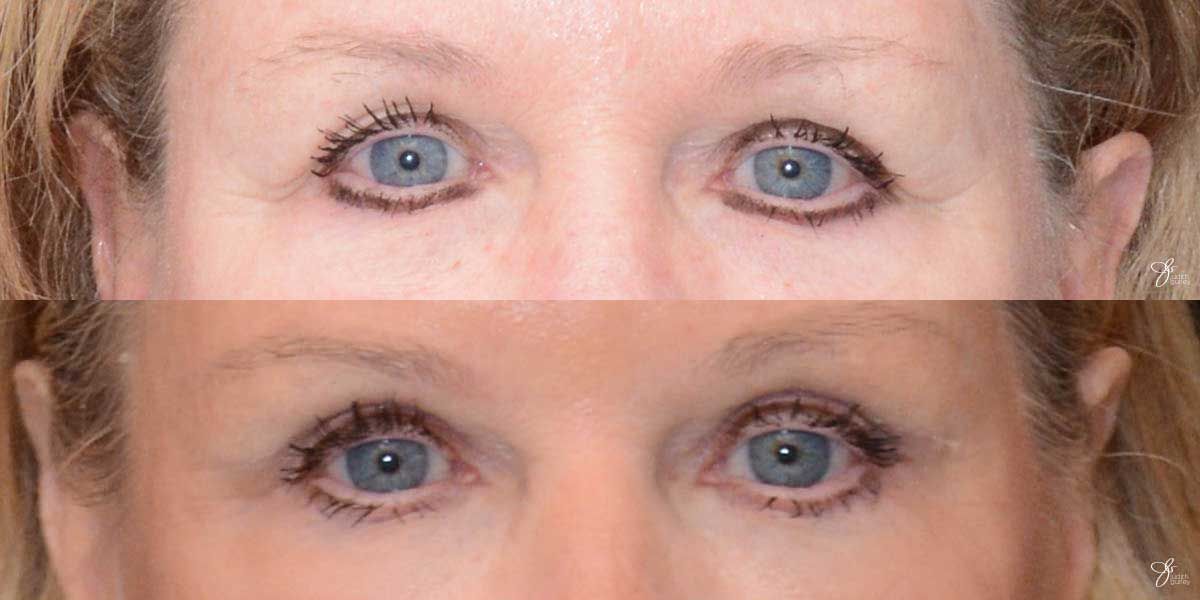 Eyelid Lift Before & After