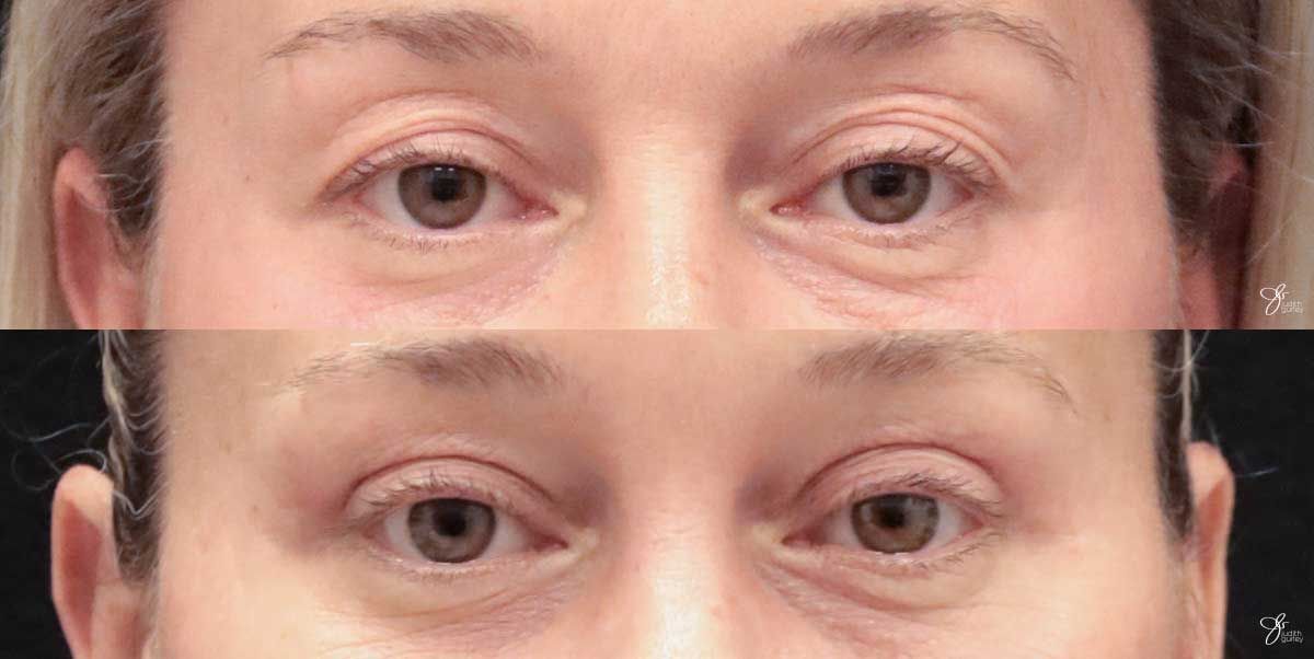 Eyelid Lift Before & After