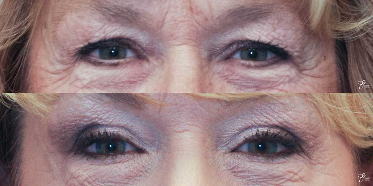 Eyelid Lift Before & After
