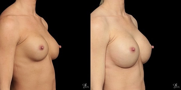 Implant Removal Replacement Before & After