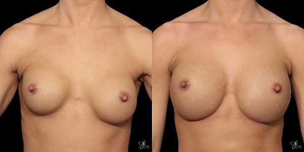 Implant Removal Replacement Before & After