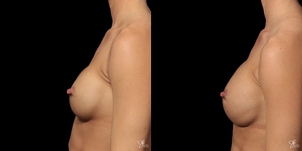 Implant Removal Replacement Before & After