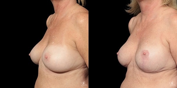 Implant Removal Replacement Before & After