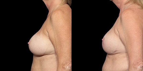 Implant Removal Replacement Before & After