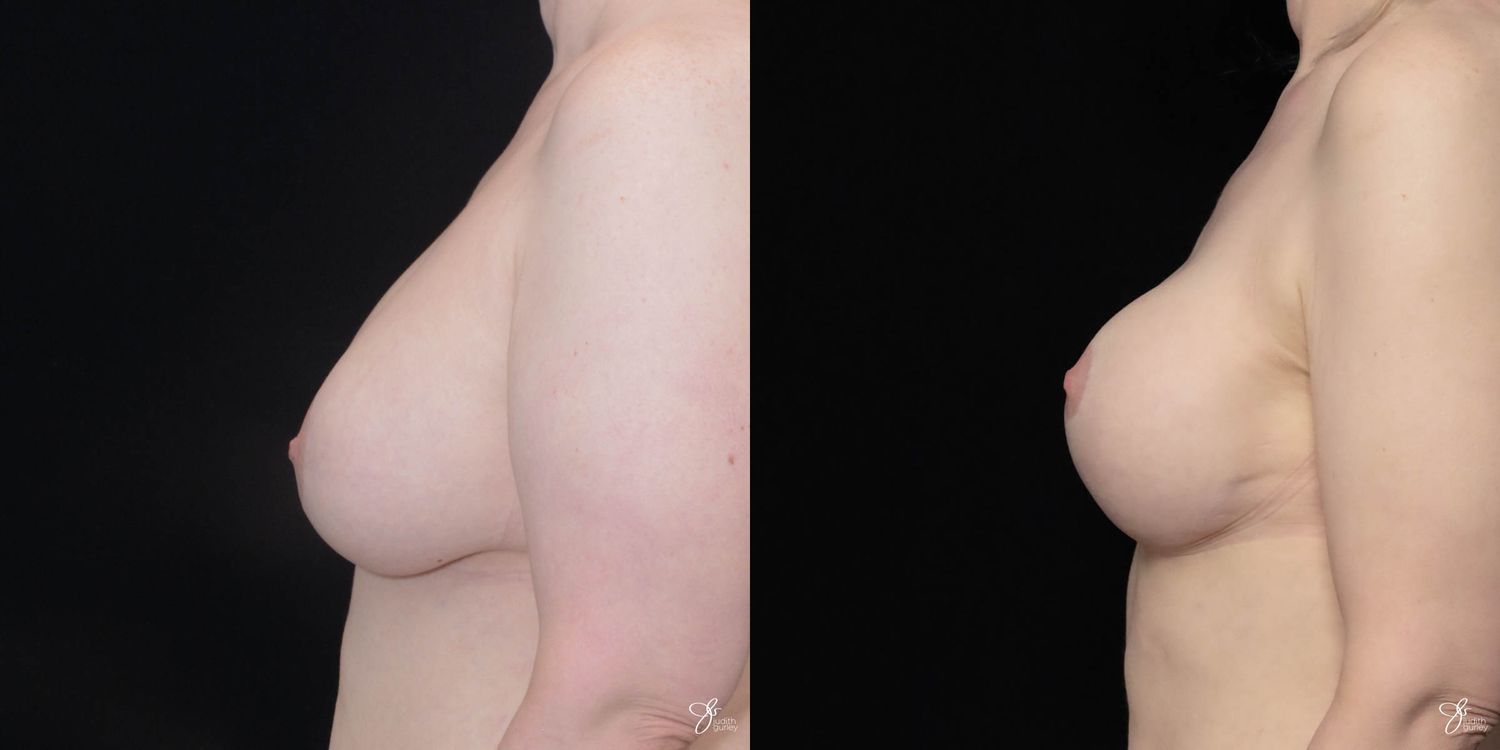 Implant Removal Replacement Before & After