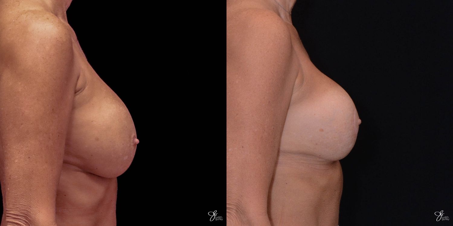 Implant Removal Replacement Before & After