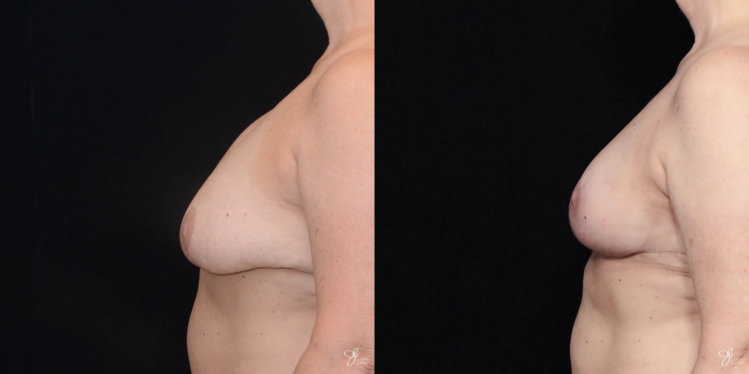 Implant Removal Replacement Before & After