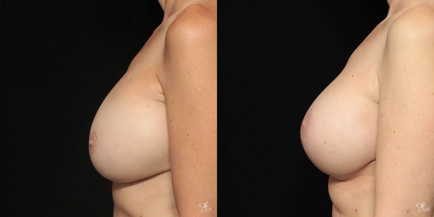 Implant Removal Replacement Before & After