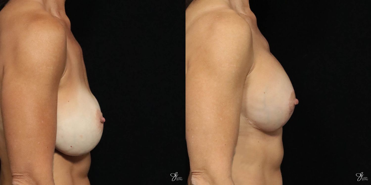 Implant Removal Replacement Before & After