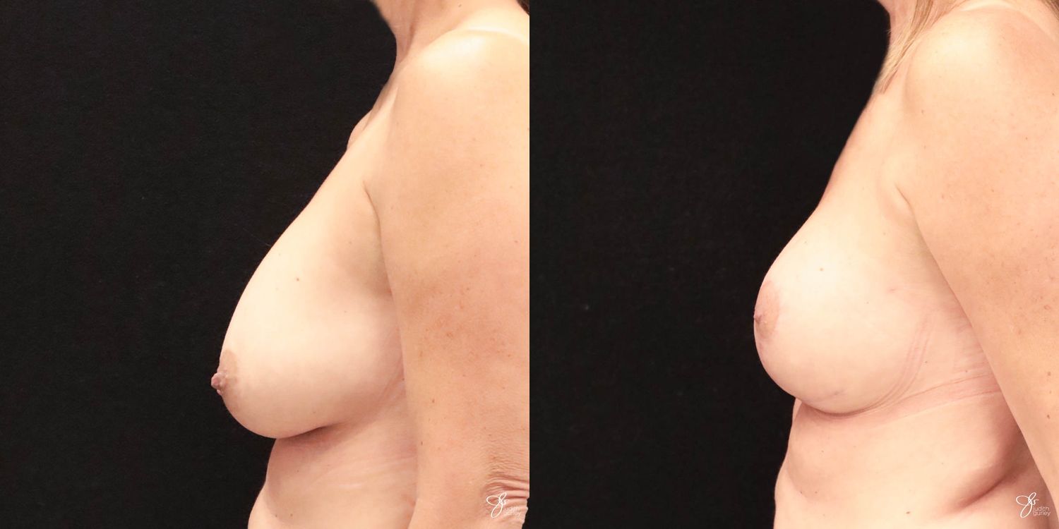 Implant Removal Replacement Before & After