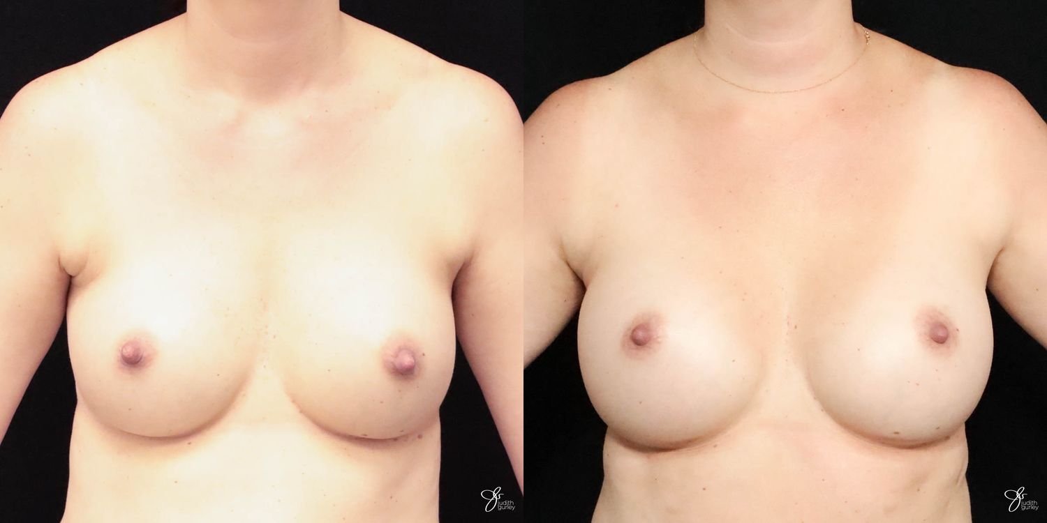 Implant Removal Replacement Before & After