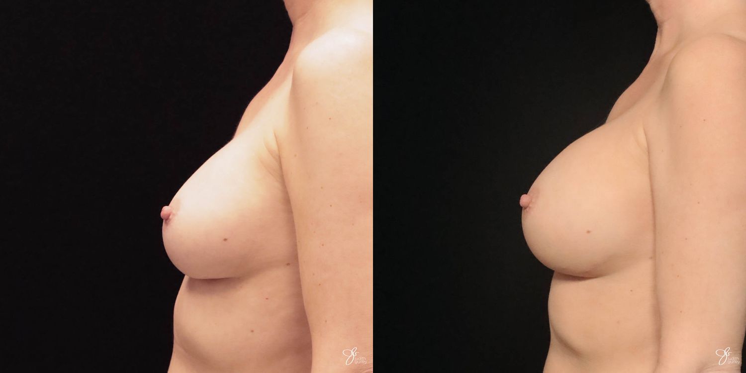 Implant Removal Replacement Before & After