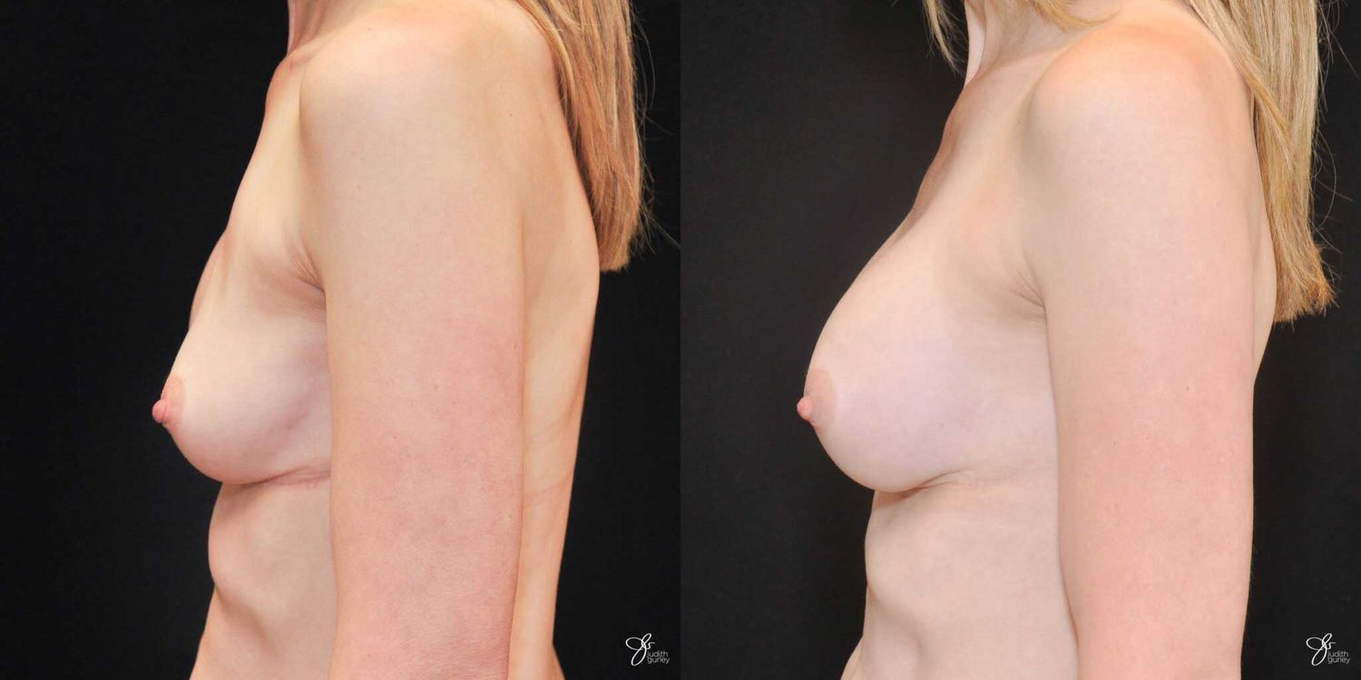 Implant Removal Replacement Before & After