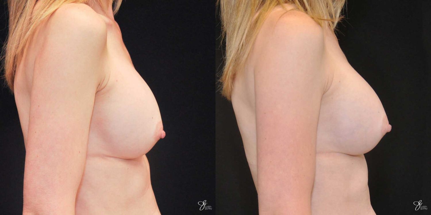 Implant Removal Replacement Before & After