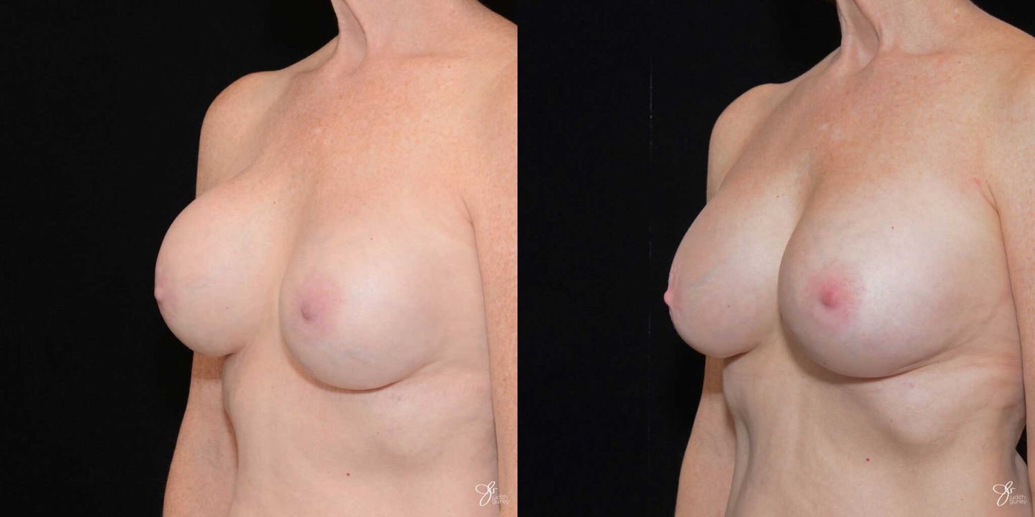 Implant Removal Replacement Before & After