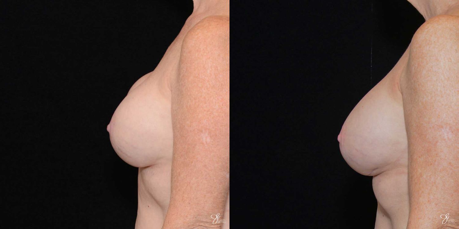 Implant Removal Replacement Before & After