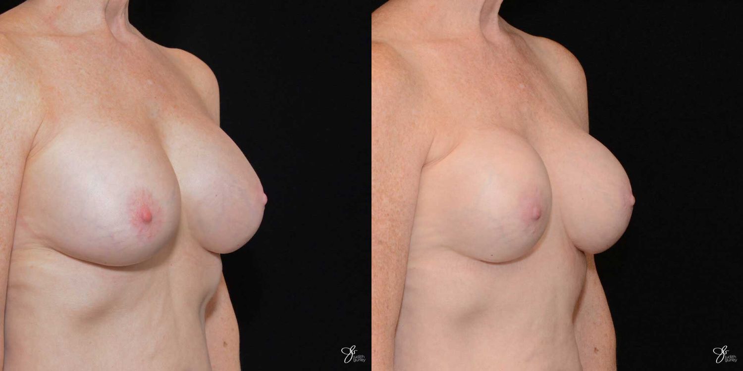 Implant Removal Replacement Before & After