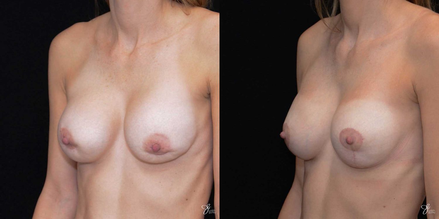 Implant Removal Replacement Before & After