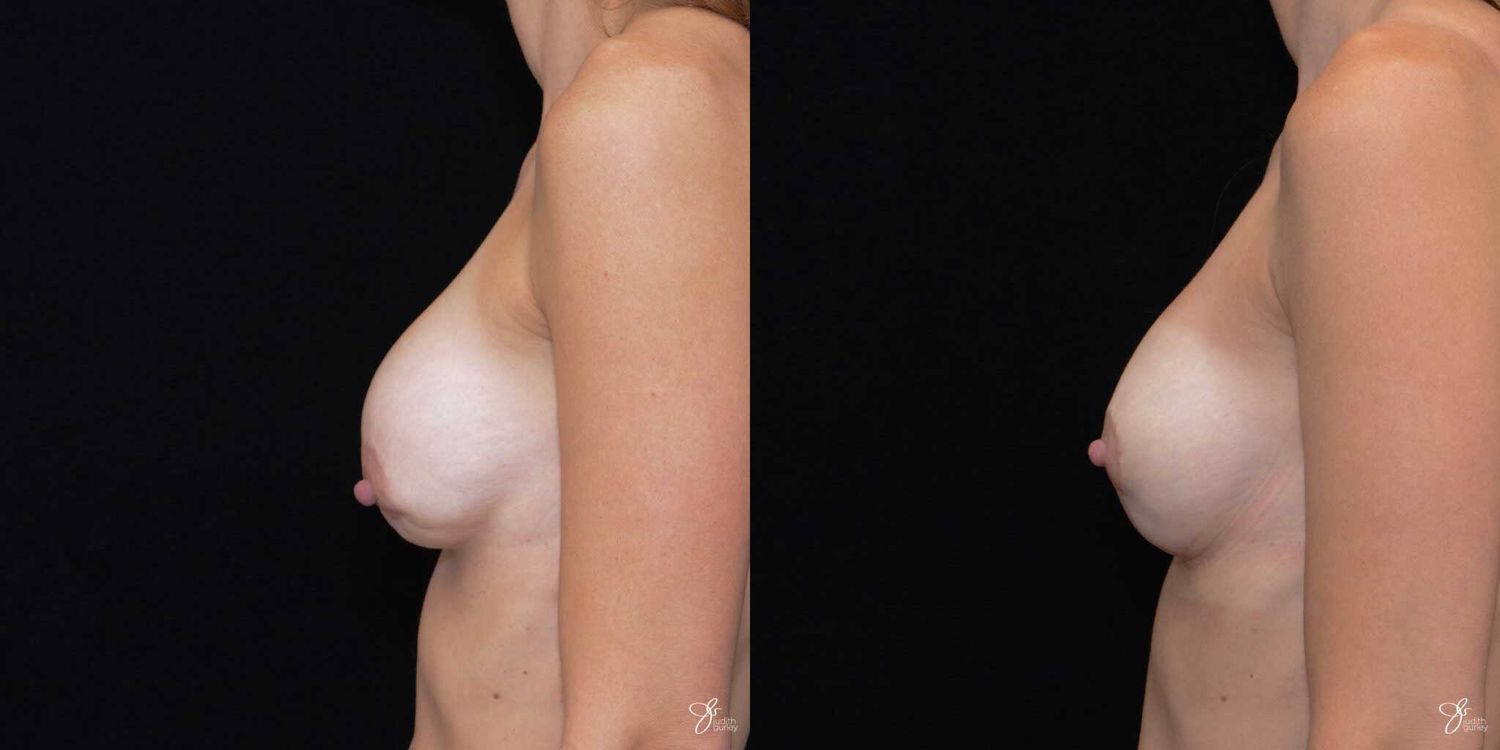 Implant Removal Replacement Before & After