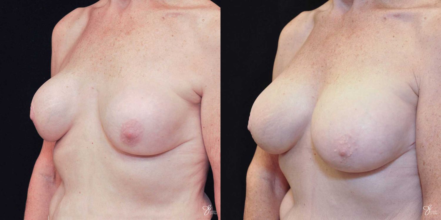 Implant Removal Replacement Before & After