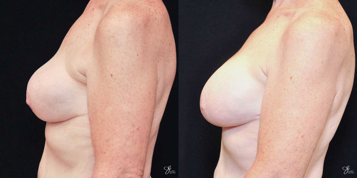 Implant Removal Replacement Before & After