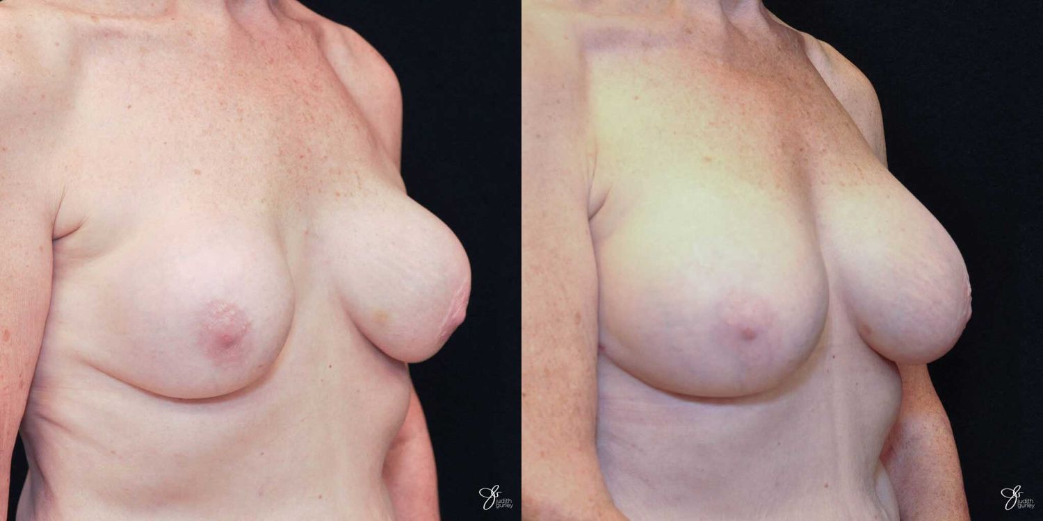 Implant Removal Replacement Before & After