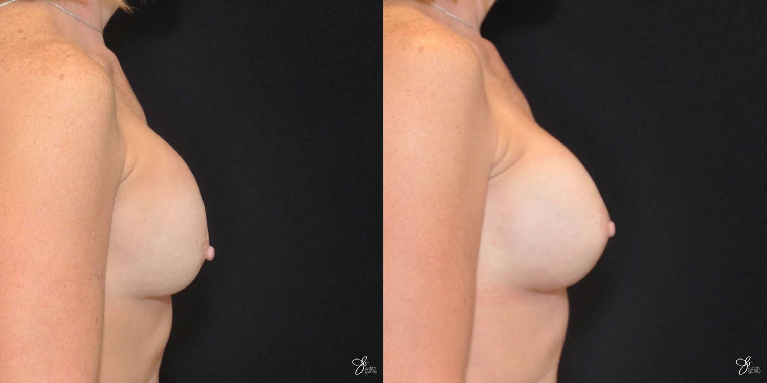 Implant Removal Replacement Before & After