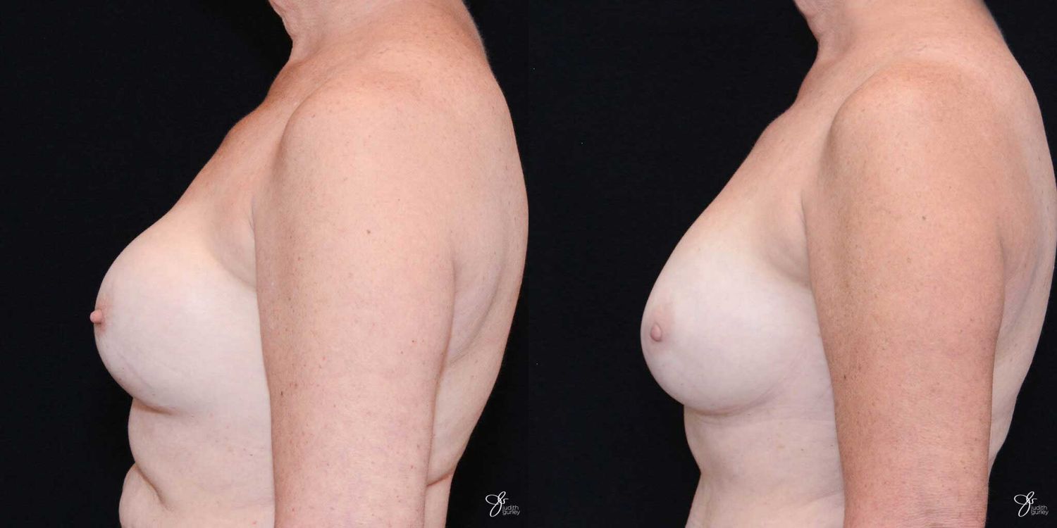 Implant Removal Replacement Before & After