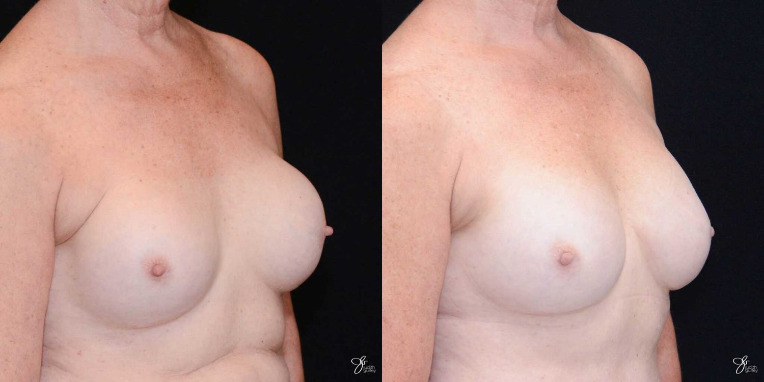 Implant Removal Replacement Before & After