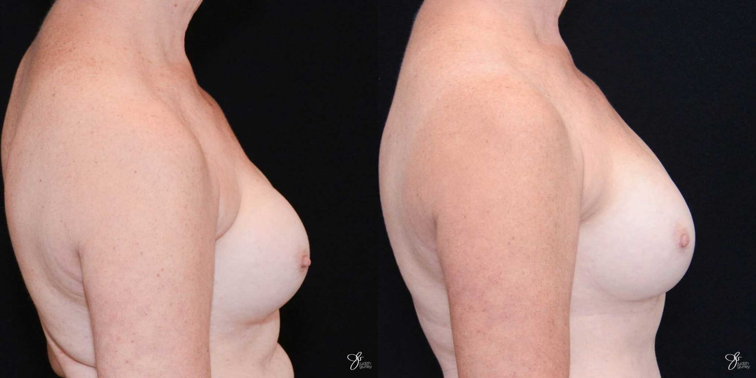 Implant Removal Replacement Before & After