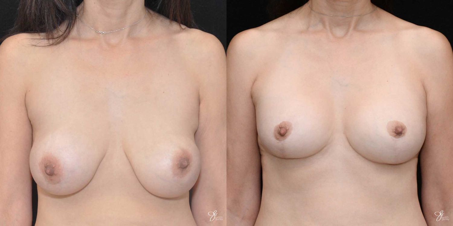 Implant Removal Replacement Before & After