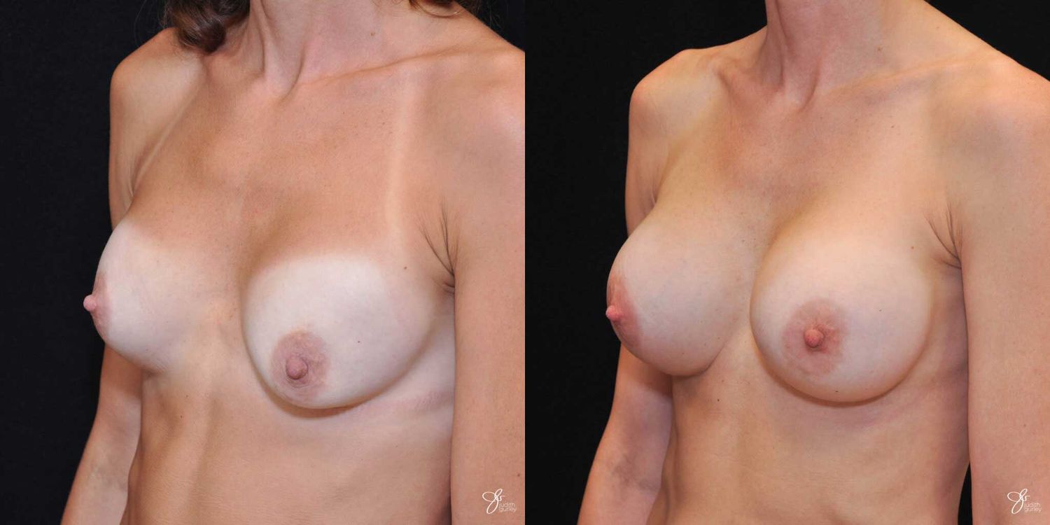 Implant Removal Replacement Before & After