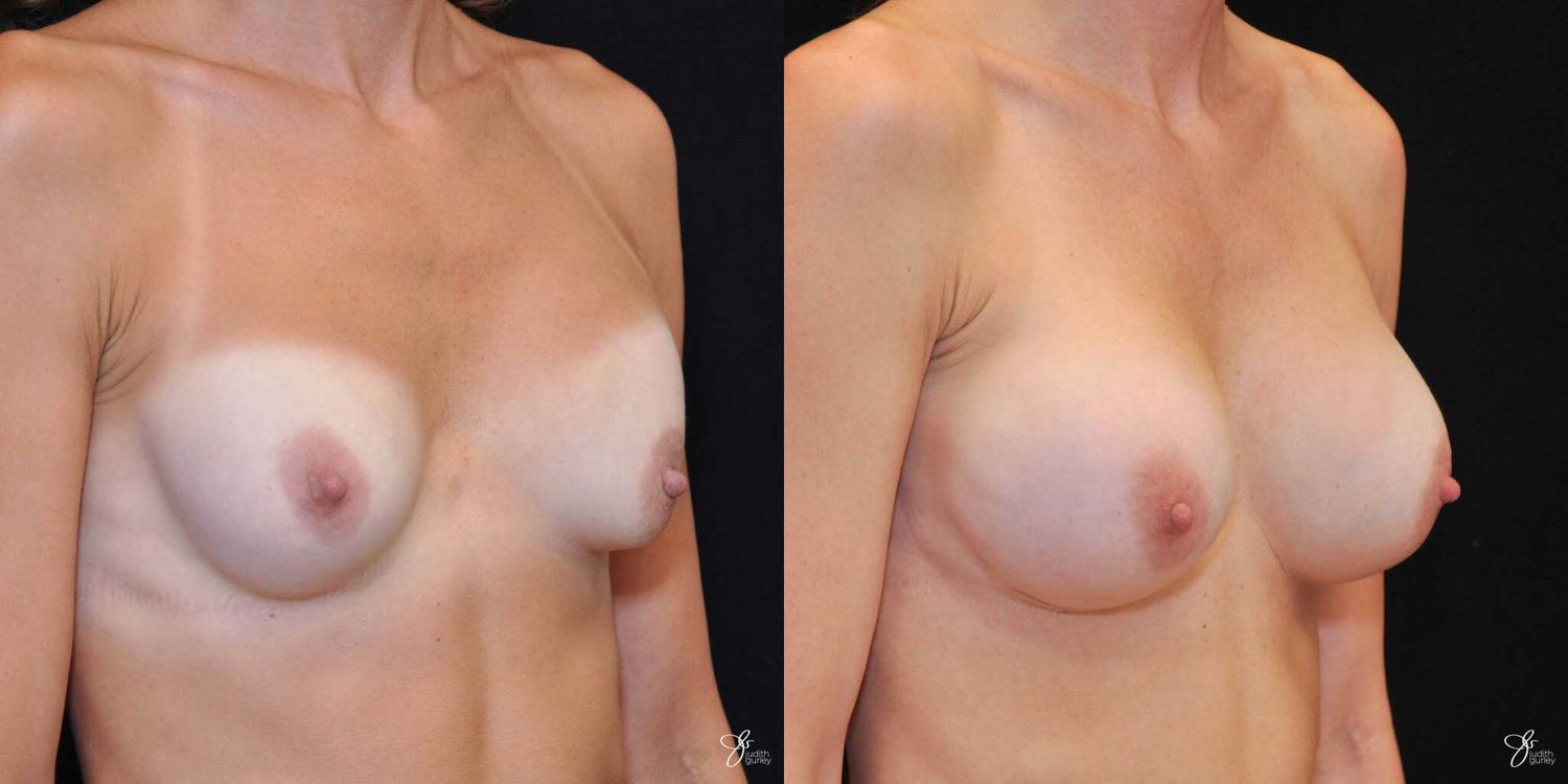 Implant Removal Replacement Before & After