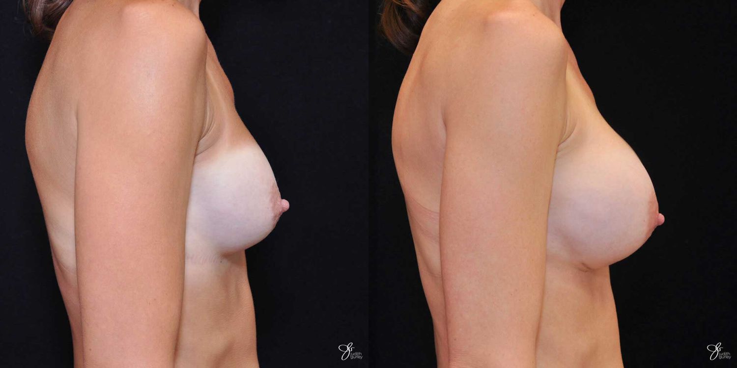 Implant Removal Replacement Before & After