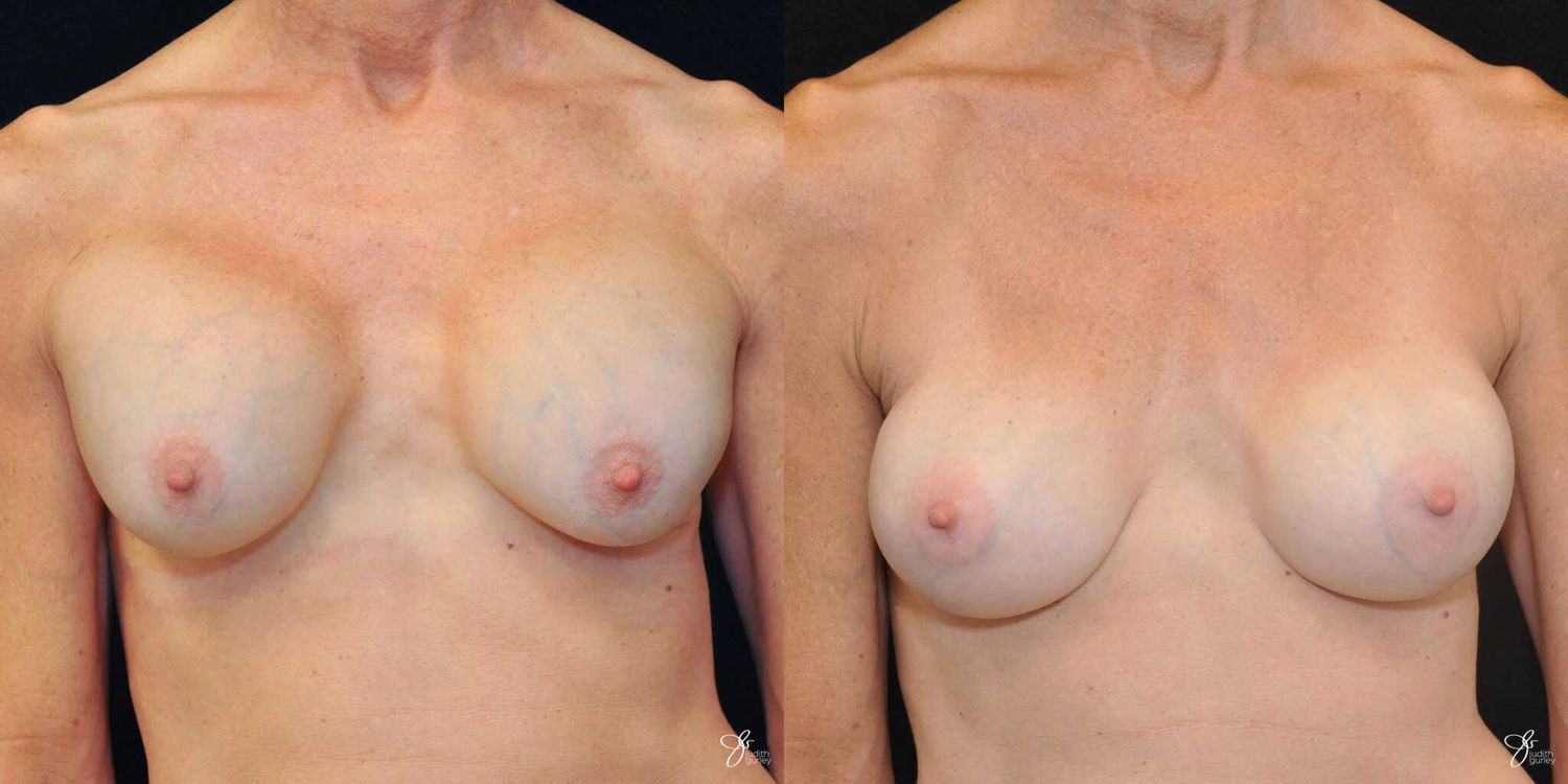 Implant Removal Replacement Before & After