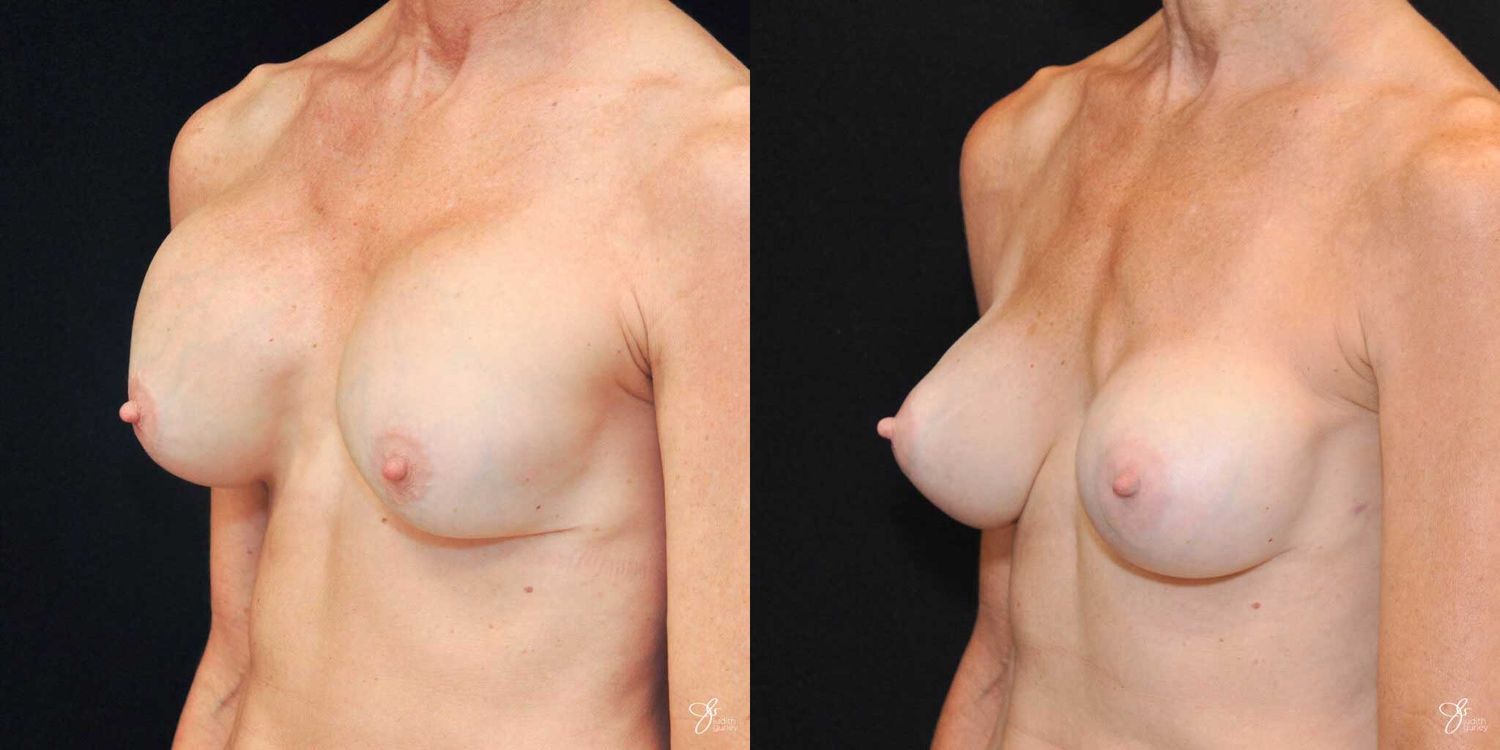 Implant Removal Replacement Before & After