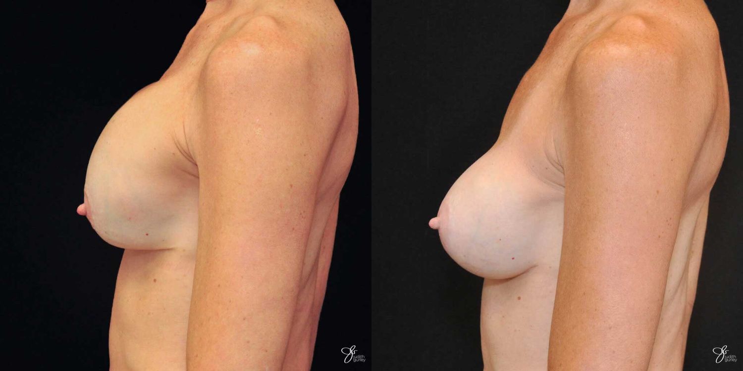 Implant Removal Replacement Before & After