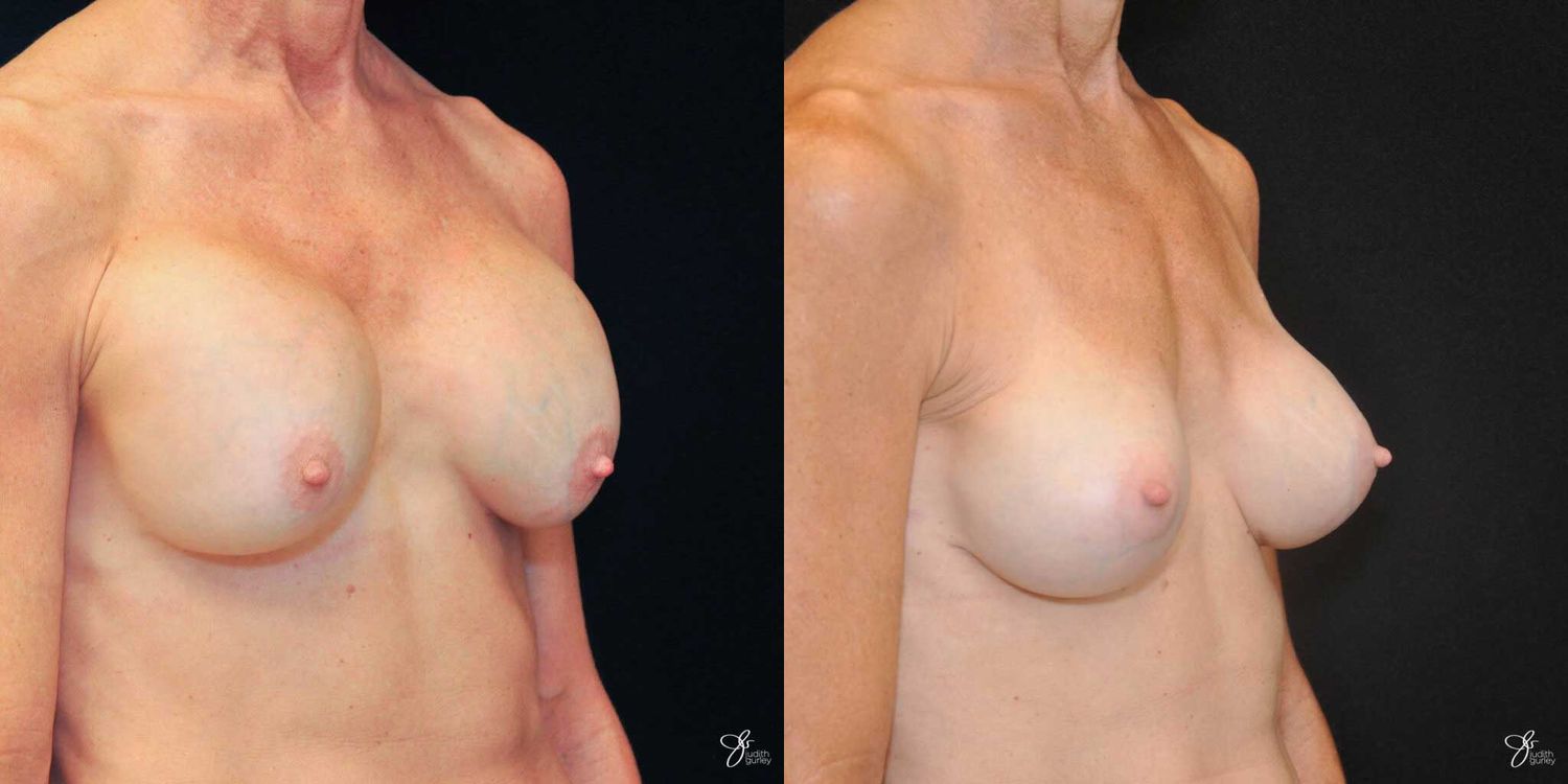 Implant Removal Replacement Before & After