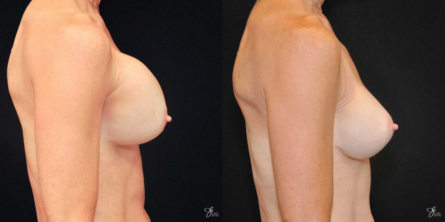 Implant Removal Replacement Before & After