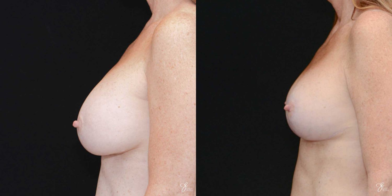 Implant Removal Replacement Before & After