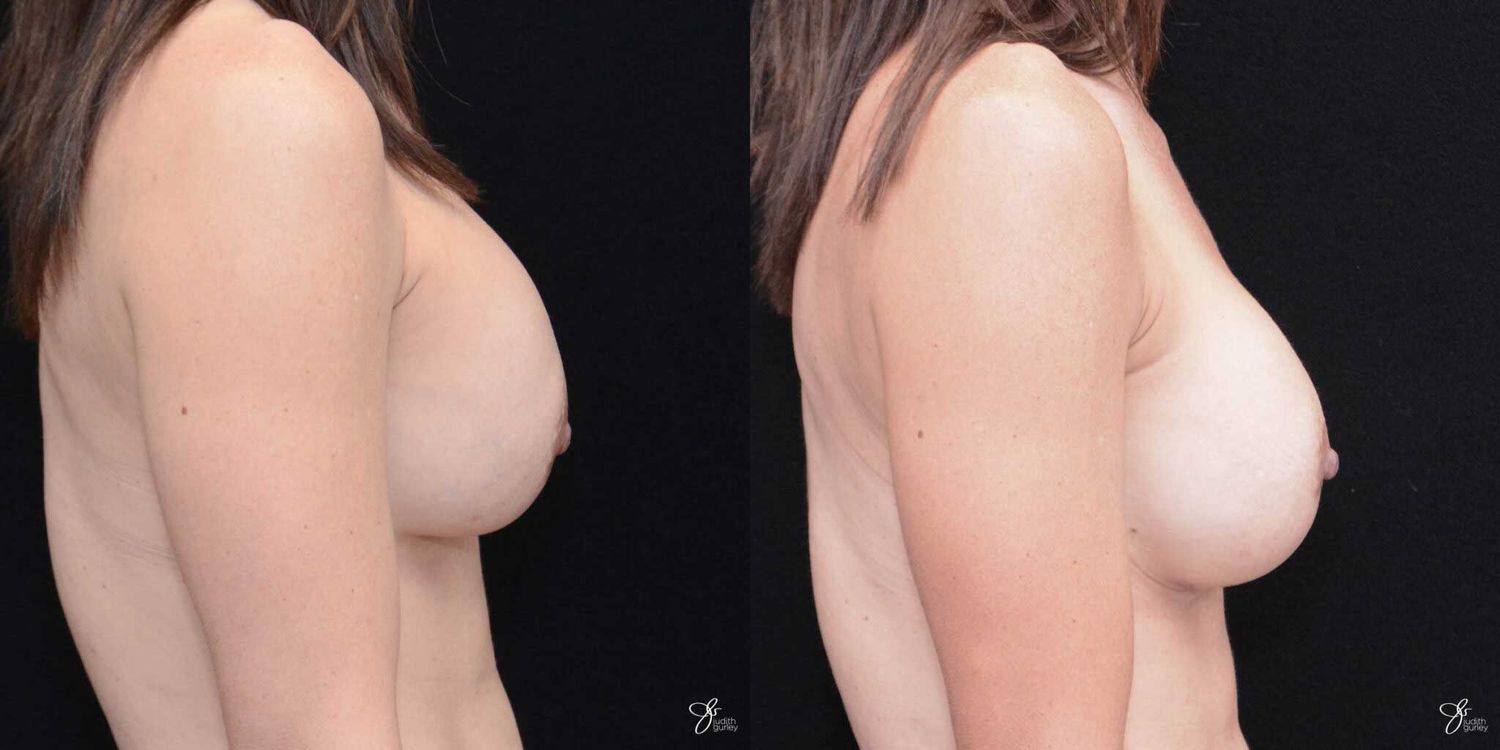 Implant Removal Replacement Before & After