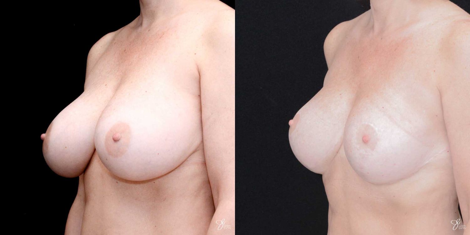 Implant Removal Replacement Before & After