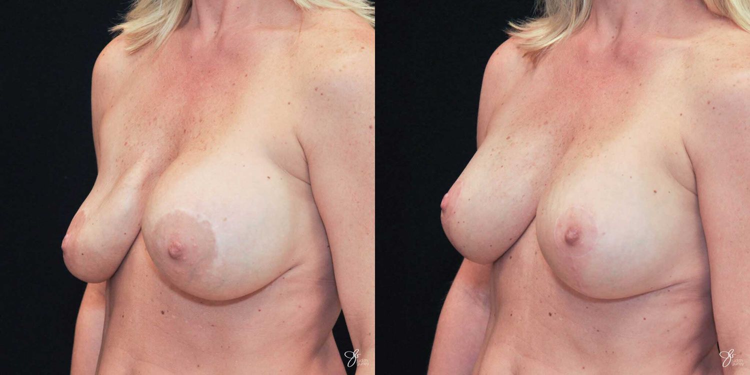 Implant Removal Replacement Before & After