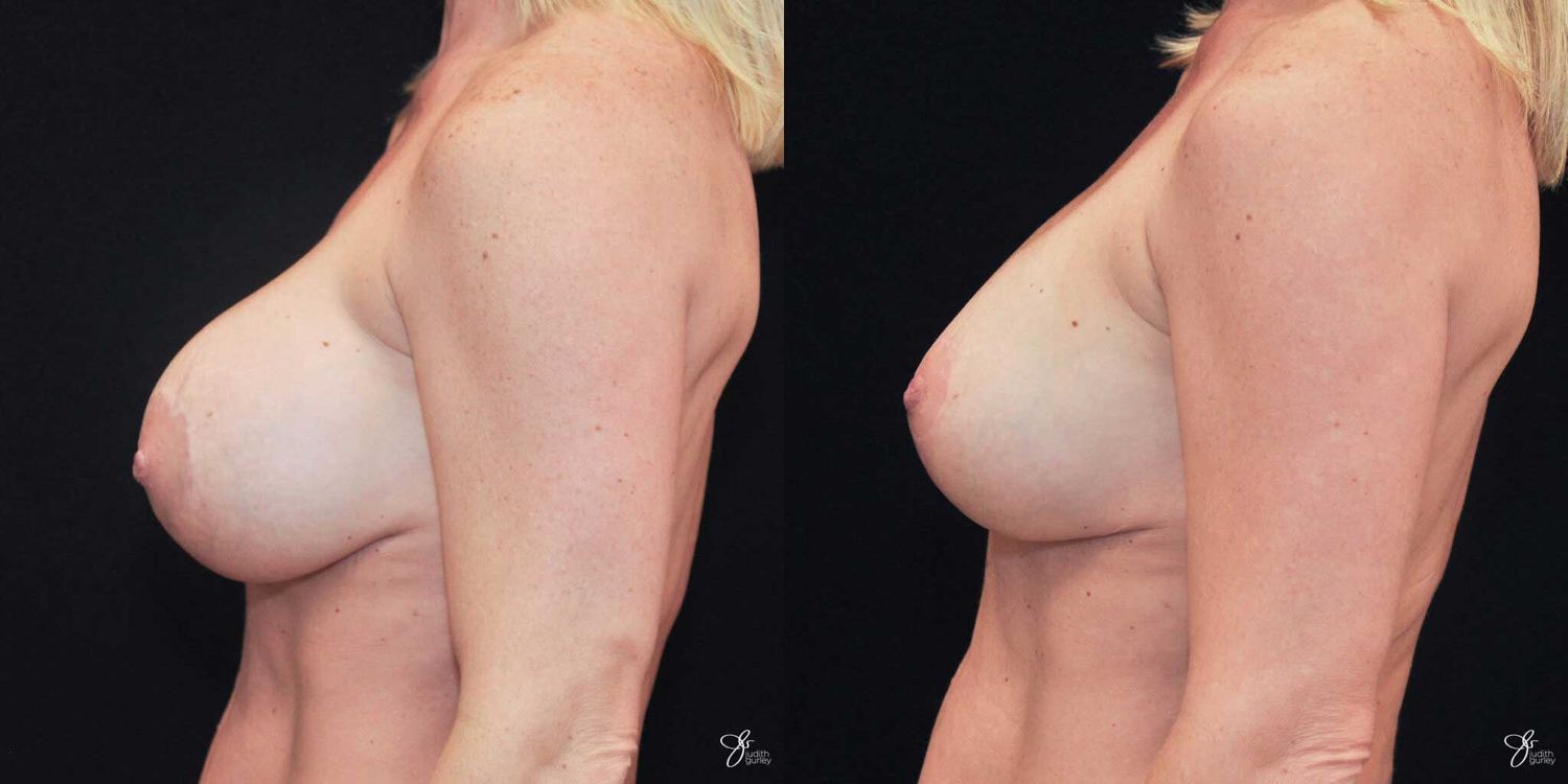 Implant Removal Replacement Before & After