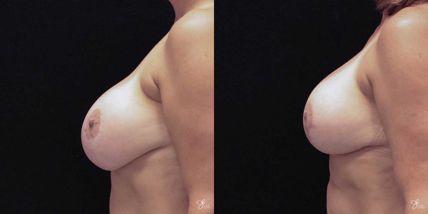 Implant Removal Replacement Before & After