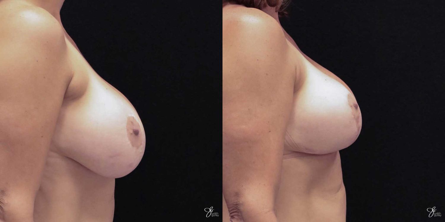 Implant Removal Replacement Before & After